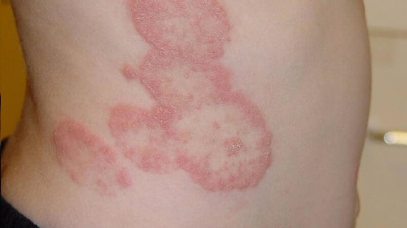 Severe skin (fungal) infections